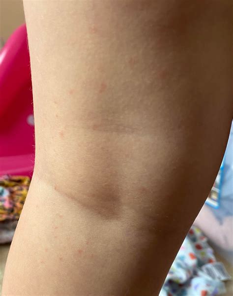 Is this the early stages of chickenpox? There are confirmed cases in