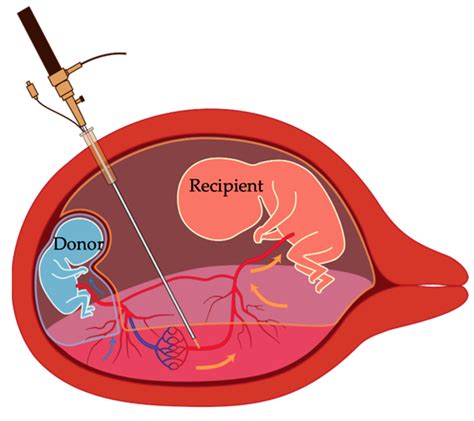 twin  twin transfusion syndrome treatment tracking