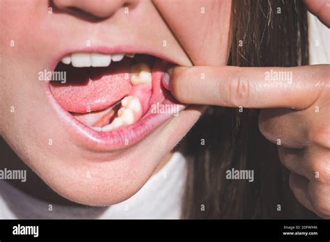 teeth tooth loss  res stock photography  images alamy