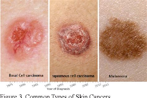 Main Types Of Skin Cancer