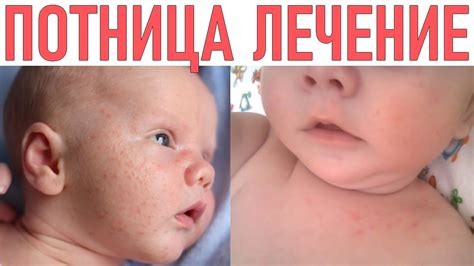 ПОТНИЦА У РЕБЕНКА | Как лечить, симптомы и профилактика - YouTube