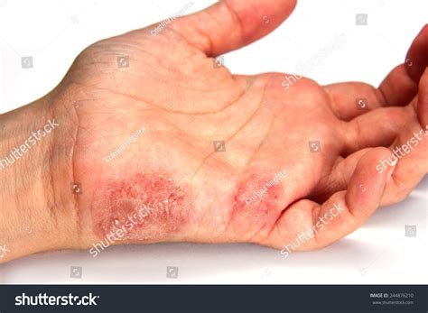 tinea manuum images stock  vectors shutterstock
