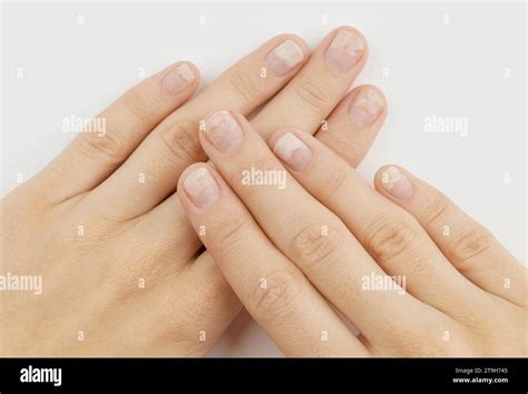 Onycholysis nail hi-res stock photography and images - Alamy