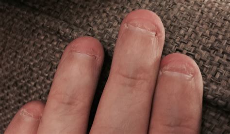 I have a bad habit of picking my fingernails. : WTF