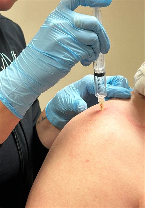 Prolozone Injection Therapy in Clive, IA | vIVid Wellness & Aesthetics
