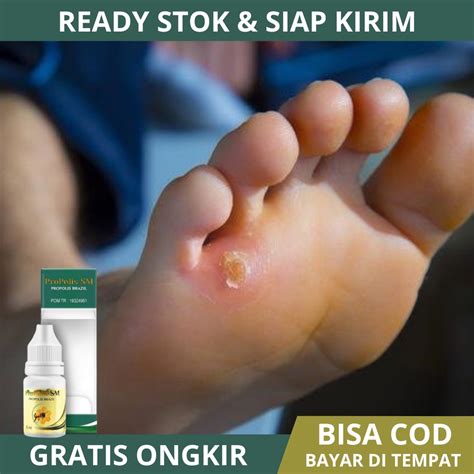 jual obat mata ikan obat mata ikan  kaki  tangan obat mata ikan