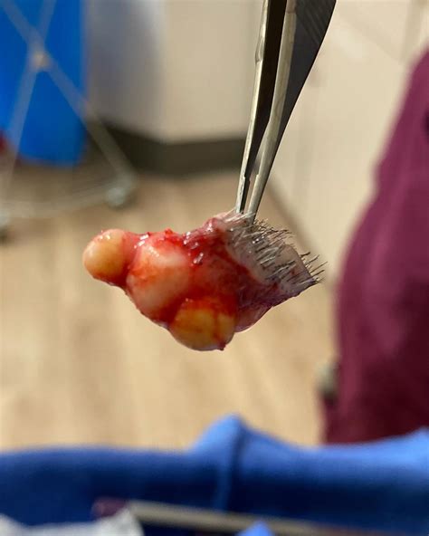 What is a Pilar Cyst? 🧐 A pilar cyst,... - Dr. Maansi Doshi