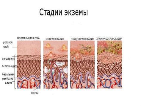 Экземаның клиникалық көрінісі - презентация онлайн