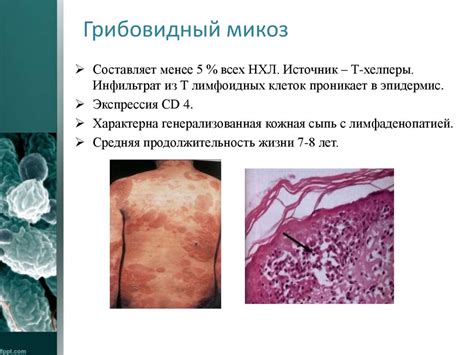 Неходжкинские лимфомы - презентация онлайн