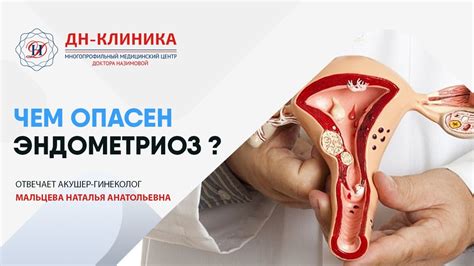 ЭНДОМЕТРИОЗ. Чем опасен? Лечить или нет? ДН-Клиника. Москва - YouTube