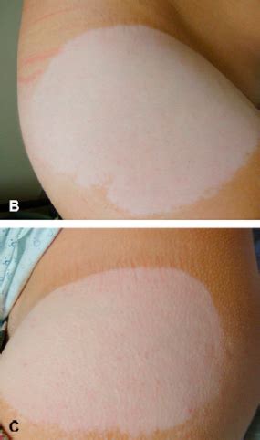 FDA Drug Safety Communication: FDA reporting permanent skin color ...