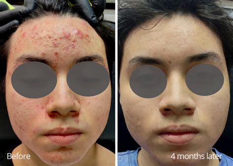 acne treatment beauty medical center