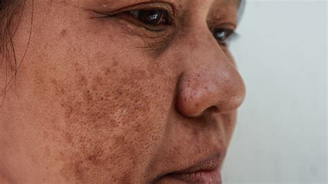Melasma: Causes, symptoms, pictures & treatment