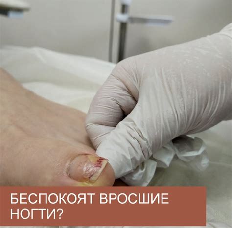 Вас беспокоит ВРОСШИЙ НОГОТЬ на ноге или руке, знайте, что решить эту ...