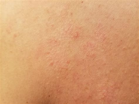 What Are Dry Skin Patches A Sign Of at Jerry Chism blog