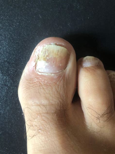Fußnagel seitlich abgelöst und Fusspilz - Was tun, wie das Einwachsen