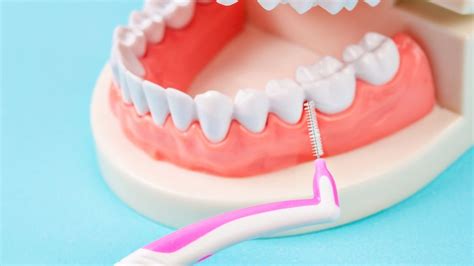 Como Usar A Escova Interdental - Escova interdental: o que é, como usar e preço - Clinica OralDents