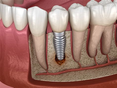 Complications Of Dental Implants With Bone Grafts at Robert Fabry blog