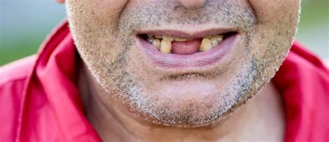 Tooth Loss: Causes, Consequences, and Treatment Options