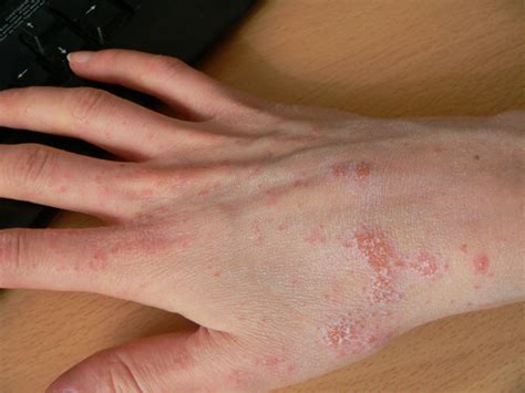 Athlete's Foot On Your Hand: Symptoms, Causes and Treatments - Destroy ...