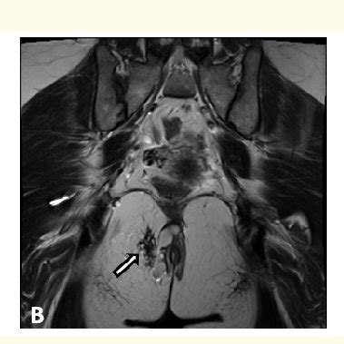 mri pelvis axial  weighted image   axial  weighted image