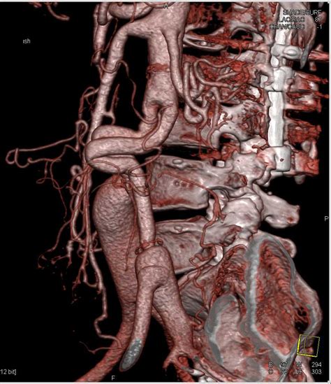 Ehlers-Danlos Syndrome with Multiple Aneurysms - Vascular Case Studies ...