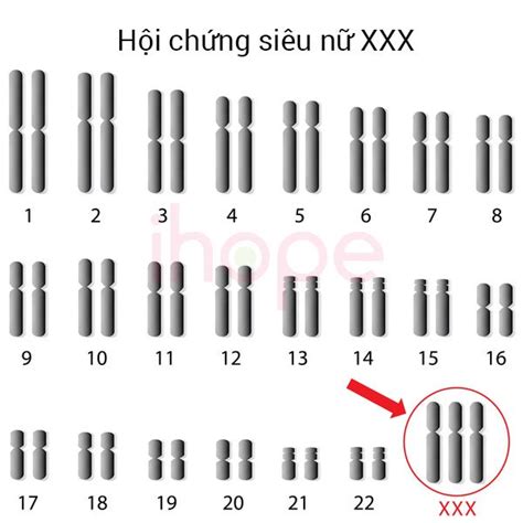 Hội chứng siêu nữ XXX