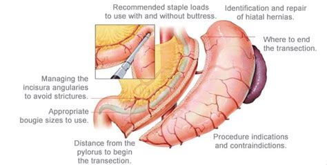 Robotic Approach Falls Short For Gastric Sleeve