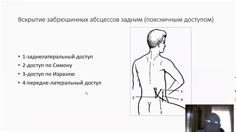 ОСЛОЖНЕНИЯ ОСТРОГО АППЕНДИЦИТА - YouTube