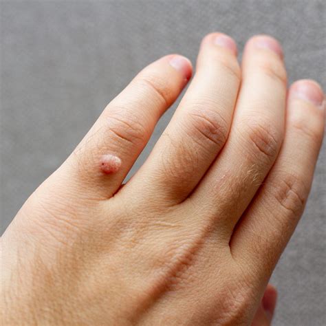 Warts - MMC