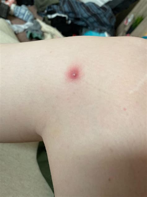 what is this on the left side of my knee? it hurts to touch : r/medical