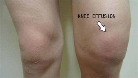 Fluid In Knee: Symptoms, Causes, Treatment By Knee Braces