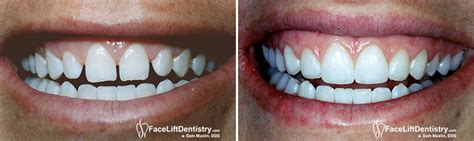 small teeth  braces dental news network