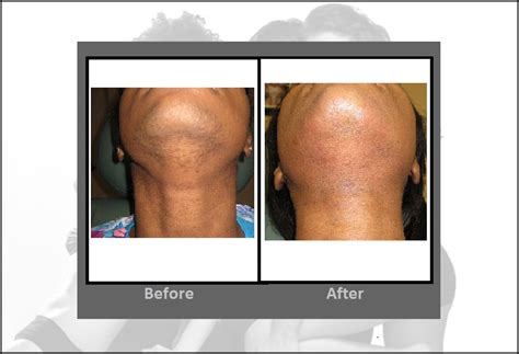 Laser Hair Removal | Cost, Before & After, FAQ | Hartford CT