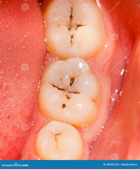 how to cure teeth cavity