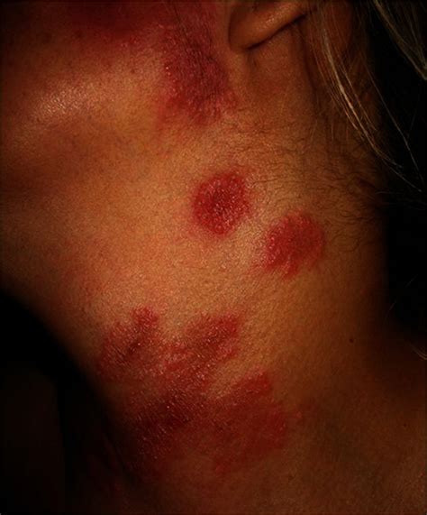 Image:Acute Febrile Neutrophilic Dermatosis (Sweet Syndrome)-MSD Manual