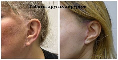 Швы после Смас лифтинга — Пластический хирург Михайлов Андрей Анатольевич
