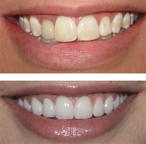Избелване на зъби | Новини | Dental.bg