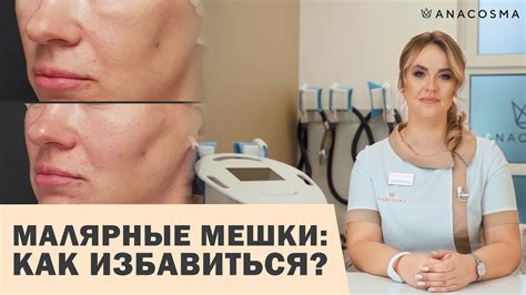 МАЛЯРНЫЕ МЕШКИ СУФЫ ПОД ГЛАЗМИ😱👉🏻 Как избавиться⁉️ - YouTube