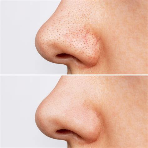 Antes E Depois Cravos No Rosto - Perfil do nariz da mulher com cravos antes e depois de descascar e ...