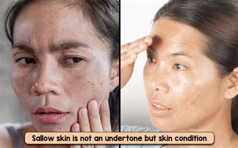 Get Rid of Sallow Skin Doing 6 Things A Day – Helping & Useful stories