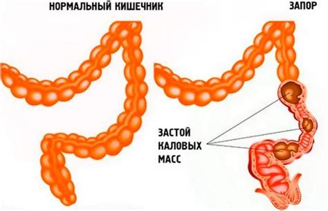 Слабительные средства. Какие выбрать таблетки от запора недорогие и ...