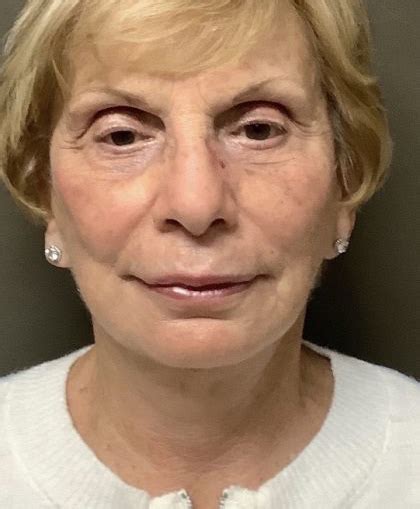 mini neck lift michigan california skin vein center