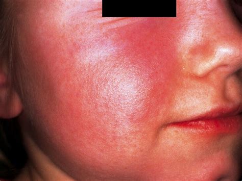 erythema infectiosum quiz erythema contagiosum yxijc