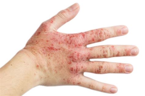 Dermatitis Atopik: Gejala, Penyebab, Pengobatan, Komplikasi