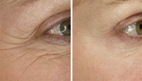PLATELET Rich PLASMA (PRP) – AY Rejuvenation