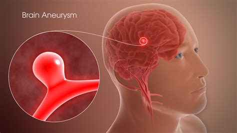 Brain Aneurysm Shown & Explained Using A 3D Medical Animation