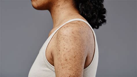 dark spot correctors demystified secrets  radiant skin