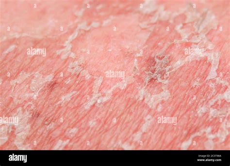 Dead Skin Cells High Resolution Stock Photography and Images - Alamy