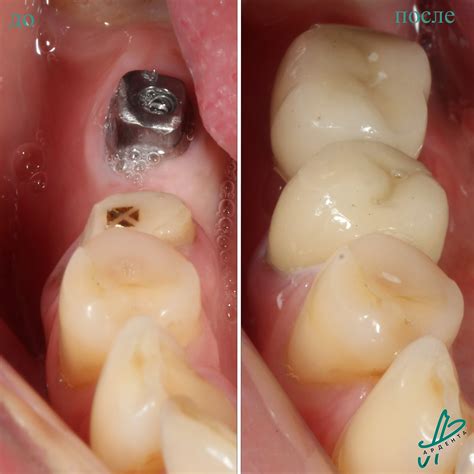 Импланты дентиум Dentium Superline в стоматологии Ардента в Ростове-на ...